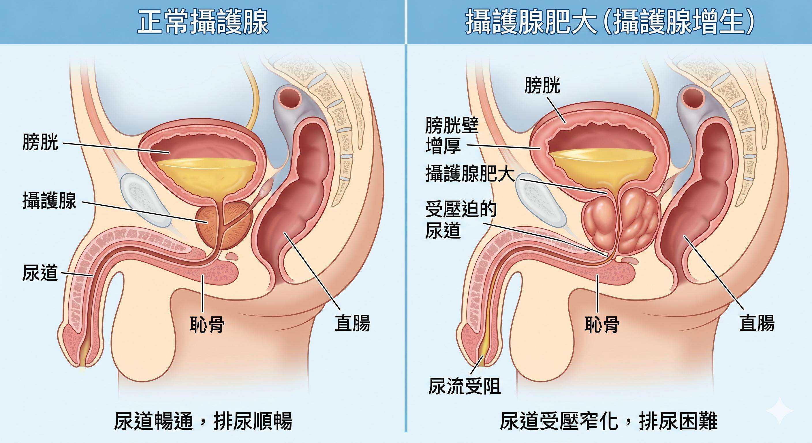 攝護腺肥大症狀與治療