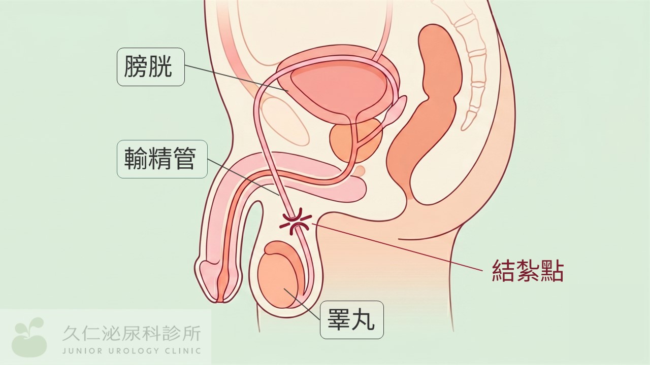 男性結紮（輸精管結紮手術）解剖示意圖：膀胱、輸精管走向與結紮位置
